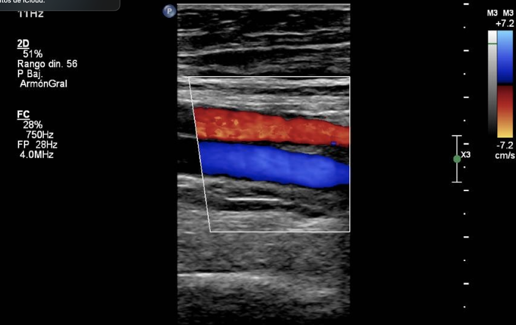 Ultrasonido Especializado Doppler Vascular